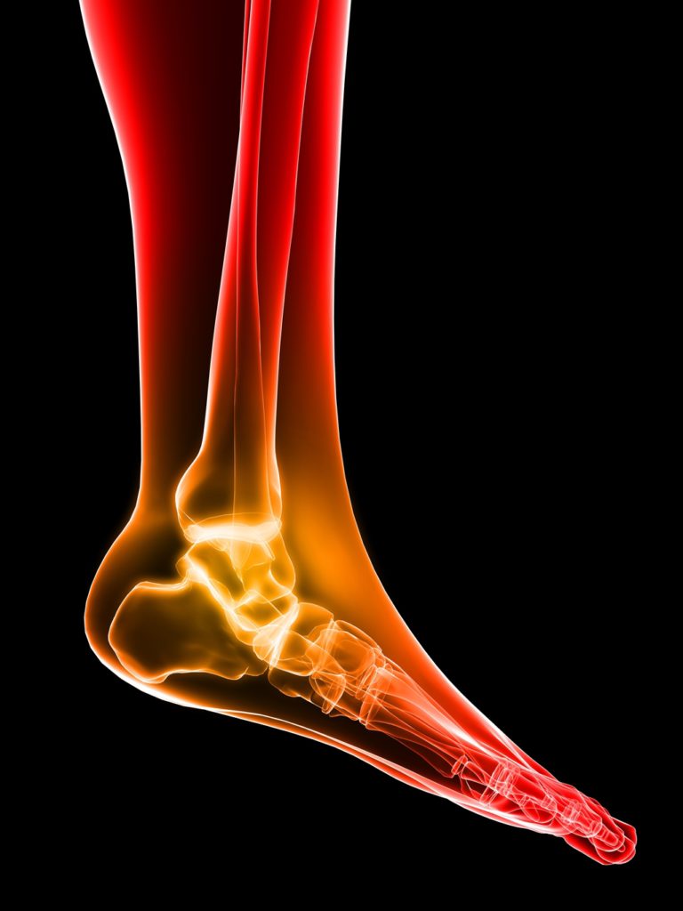 plantar fasciitis